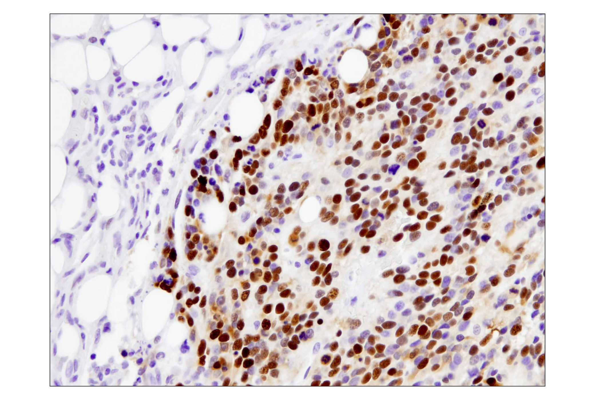 Immunohistochemistry Image 1: p53 (DO-7) Mouse mAb