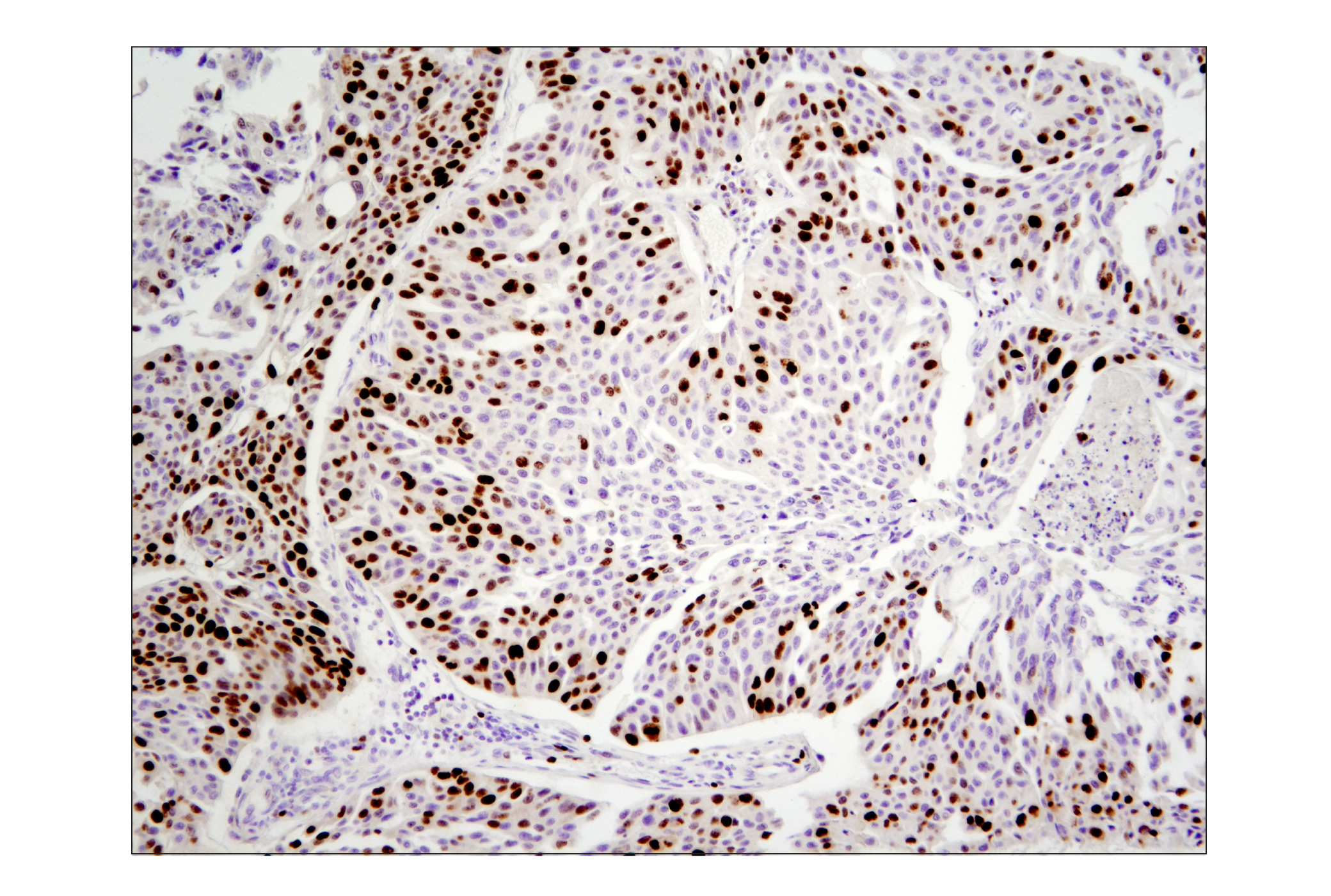 Immunohistochemistry Image 1: Ki-67 (D2H10) Rabbit mAb