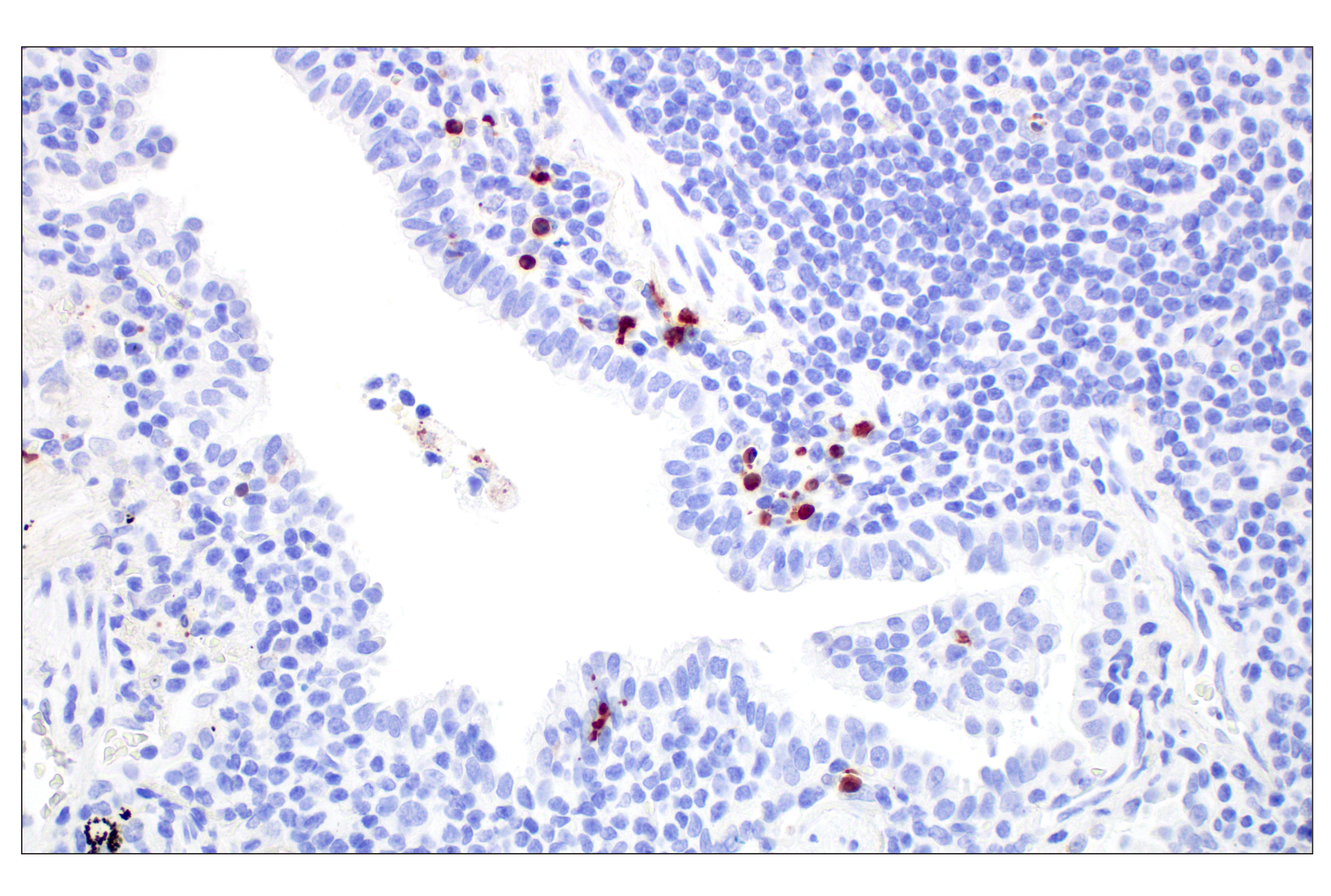 Immunohistochemistry Image 5: Cleaved Caspase-3 (Asp175) (D3E9) Rabbit mAb