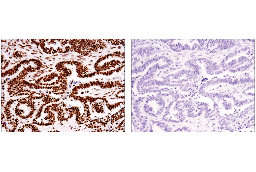 在存在非甲基肽（左图）或 K36 三甲基化肽（右图）的情况下，使用 Tri-Methyl-Histone H3 (Lys36) (D5A7)，对石蜡包埋的人卵巢浆液性乳头状癌进行免疫组织化学分析。
