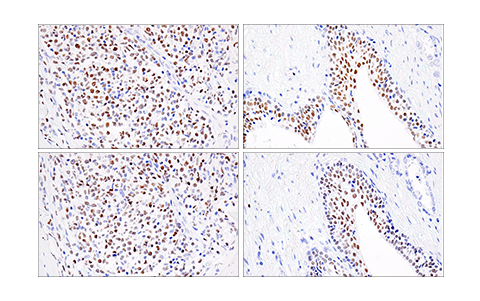 使用 Helios (E4L5U)（上图）或 Helios 抗体（下图）对石蜡包埋的人 B 细胞非霍奇金氏淋巴瘤（左图）或前列腺癌（右图）细胞进行免疫组织化学分析。这两种抗体可检测人 Helios 上的独立、独特表位。使用两种抗体获得的相似染色模式有助于确认染色特异性。