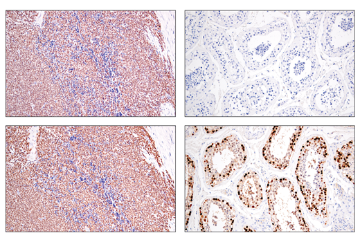 Immunohistochemistry Image 2: SS18-SSX (E9X9V) XP<sup>®</sup> Rabbit mAb (BSA and Azide Free)