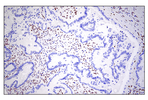 Immunohistochemistry Image 4: ZEB1 (E2G6Y) XP<sup>®</sup> Rabbit mAb (BSA and Azide Free)