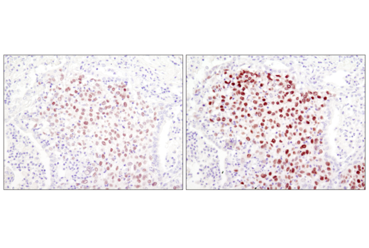 Immunohistochemical analysis of paraffin-embedded human lung squamous cell carcinoma using Sox2 (D6D9) XP® Rabbit mAb #3579 with biotin-based detection (left) or SignalStain® Boost IHC Detection Reagent (HRP, Rabbit) (right).