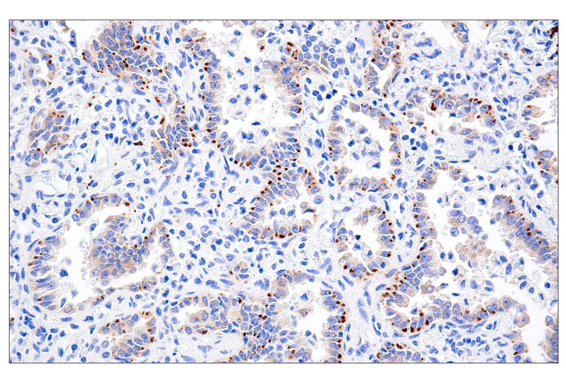 Immunohistochemistry Image 1: ROS1 (D4D6<sup>®</sup>) Rabbit mAb (Autostainer Formulated)