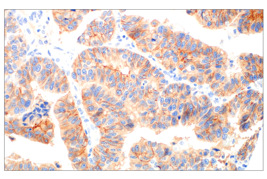 Immunohistochemistry Image 3: HER3/ErbB3 (D22C5) XP<sup>®</sup> Rabbit mAb