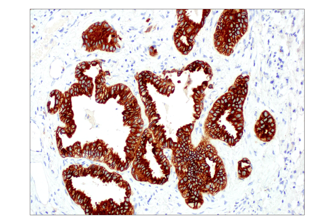 Immunohistochemistry Image 1: ALK (D5F3<sup>®</sup>) XP<sup>®</sup> Rabbit mAb