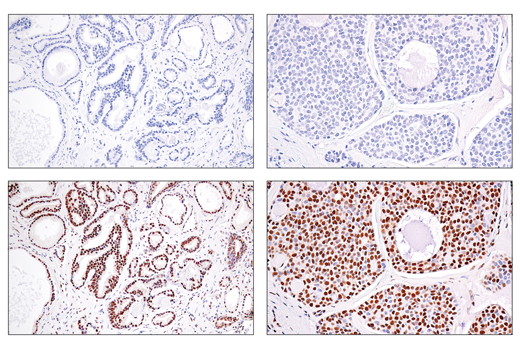 Immunohistochemistry Image 3: SS18-SSX (E9X9V) XP<sup>®</sup> Rabbit mAb (BSA and Azide Free)