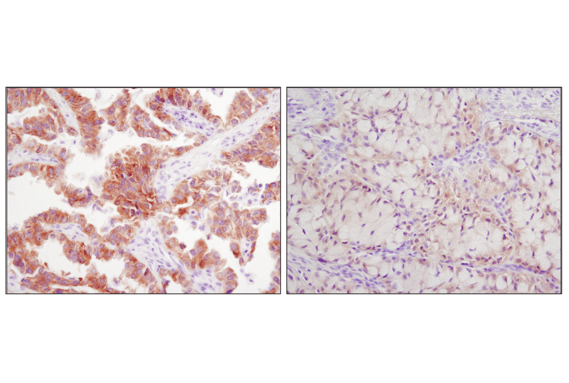 Immunohistochemistry Image 3: ALK (D5F3<sup>®</sup>) XP<sup>®</sup> Rabbit mAb
