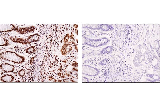 Immunohistochemistry Image 2: HMGA1 (D4F8) Rabbit mAb