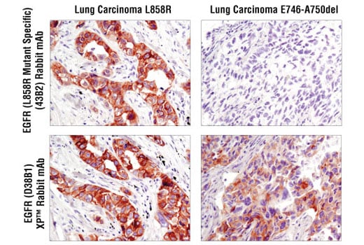 Immunohistochemistry Image 2: EGF Receptor (L858R Mutant Specific) (43B2) Rabbit mAb (BSA and Azide Free)