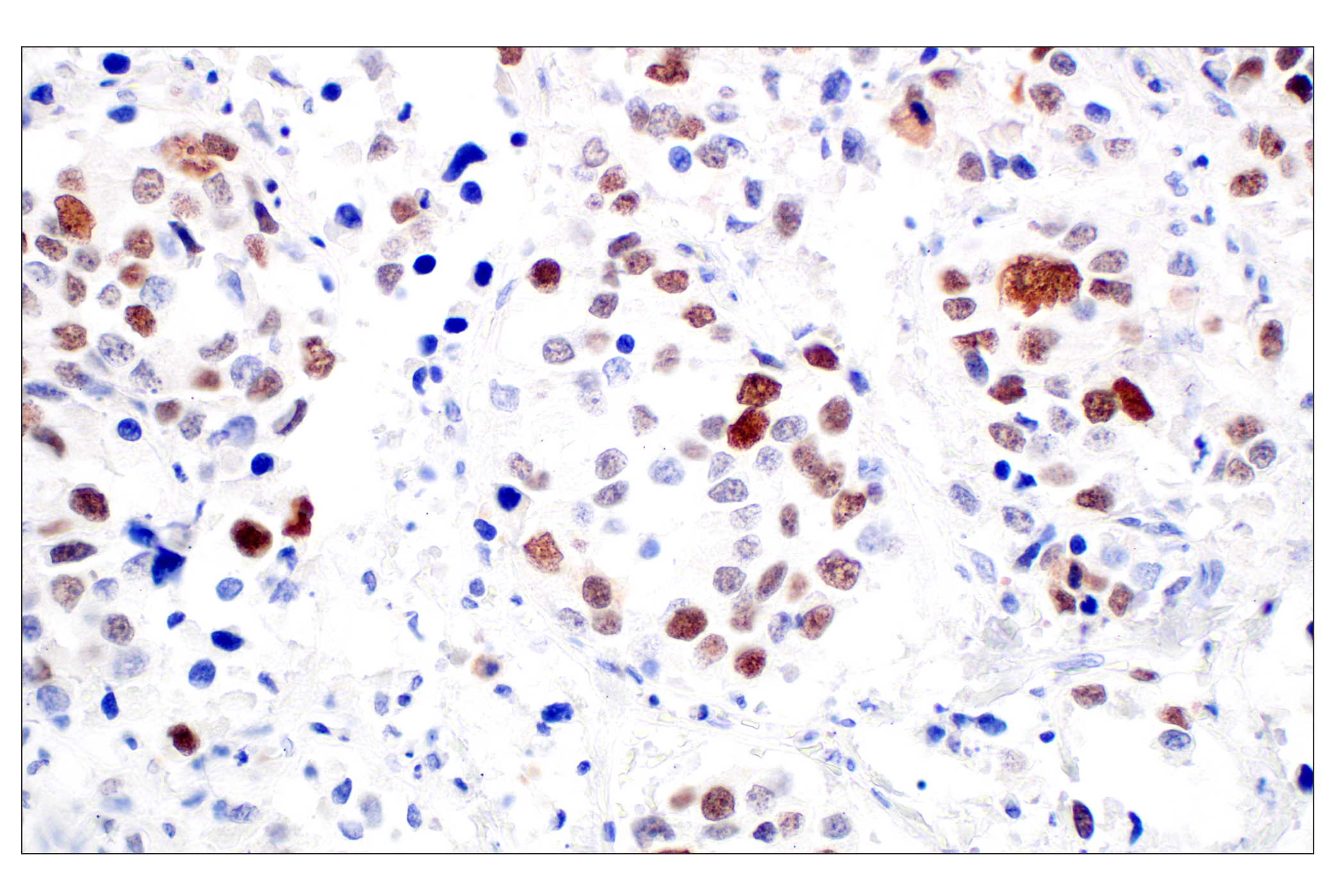Immunohistochemistry Image 6: BRCA1 (E5S9G) Rabbit mAb (BSA and Azide Free)