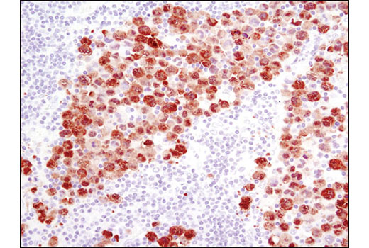 Immunohistochemistry Image 2: ALK (D5F3®) XP® Rabbit mAb