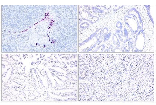 Immunohistochemistry Image 3: PMEL/Melanoma gp100 (HMB45) Mouse mAb