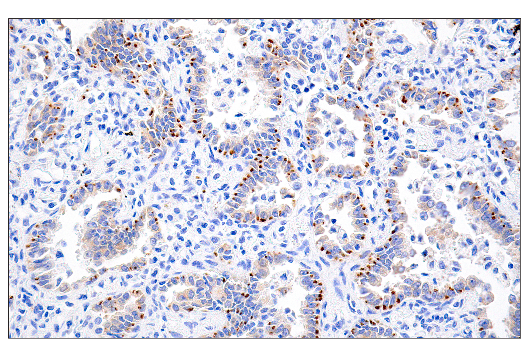 Immunohistochemistry Image 1: ROS1 (D4D6®) Rabbit mAb (Autostainer Formulated)