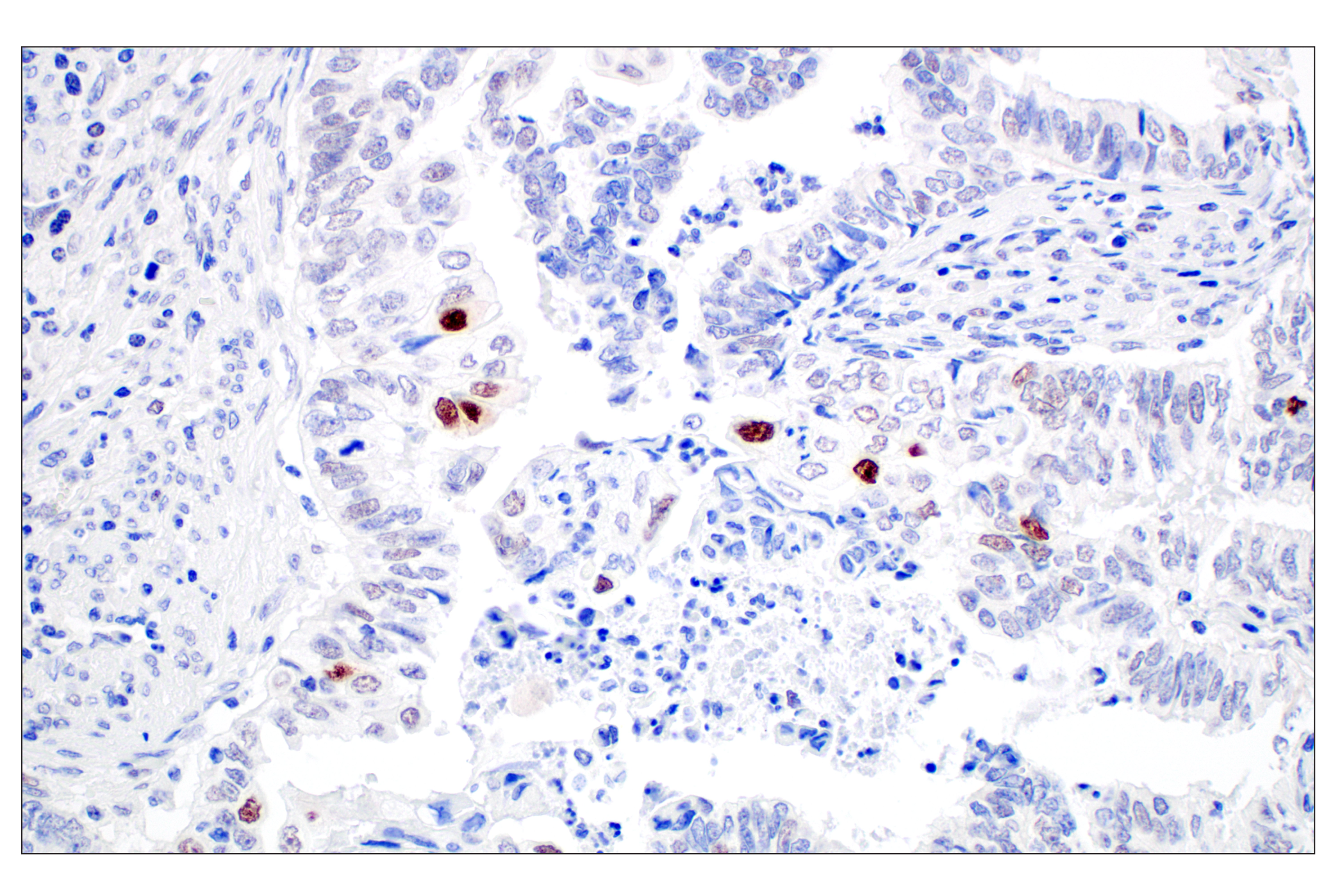 Immunohistochemistry Image 3: MDM2 (F7W7X) Rabbit mAb