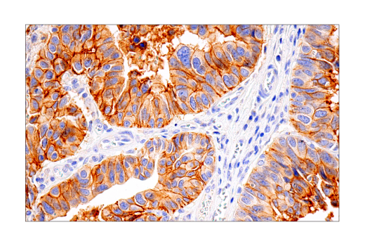 Immunohistochemistry Image 2: HER2/ErbB2 (D8F12) XP® Rabbit mAb (BSA and Azide Free)