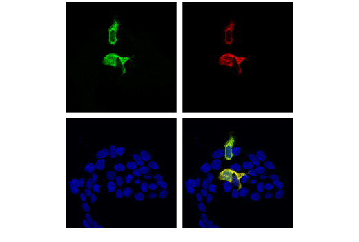 使用 MAGE-A4 (E7O1U)（上图）或 MAGE-A4 Antibody（下图）对石蜡包埋的人鳞状细胞肺癌进行免疫组织化学分析。这两种抗体可检测人 MAGE-A4 上的独立、独特表位。使用两种抗体获得的相似染色模式有助于确认染色特异性。