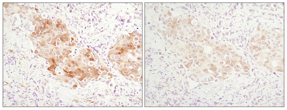 Comparison of immunohistochemical staining of paraffin-embedded human breast carcinoma tissue using SignalStain® Antibody Diluent #8112 and TBST/5% normal goat serum.