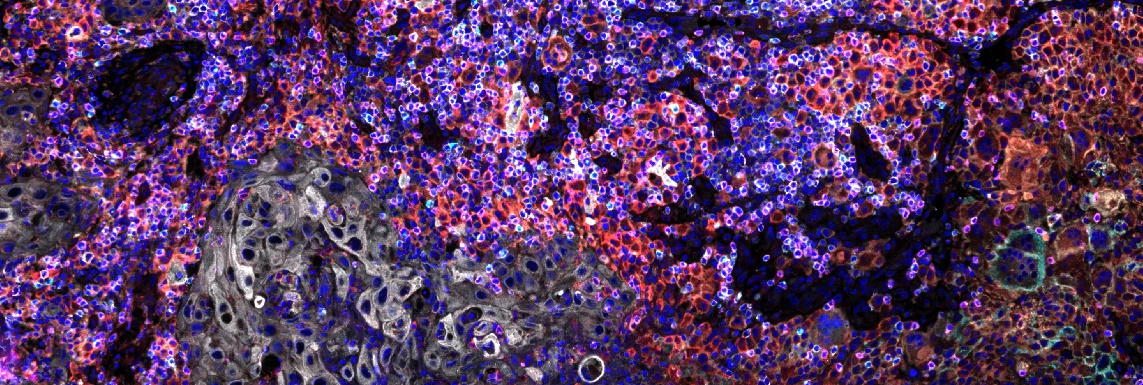 SignalStar™ multiplex immunohistochemical analysis of paraffin-embedded head and neck carcinoma.