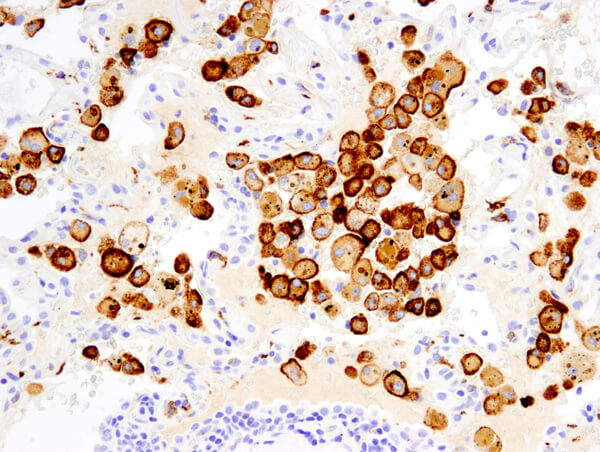CD206 MRC1 91992 非小细胞肺癌