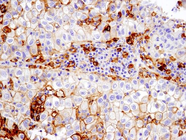 PD-L1 13684 非小细胞肺癌