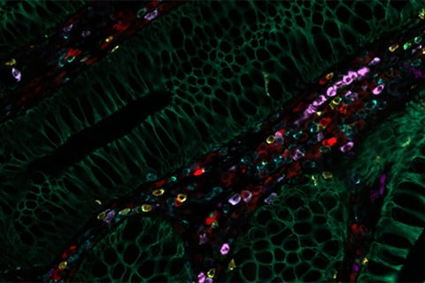 结肠腺癌附近的正常组织：组织用 30 多种 CST 抗体反复染色，并使用 Cell Dive 多重分析成像解决方案进行成像。显示了七种生物标记物：GZMB（橄榄绿）、PanCK（深绿色）、CD45（蓝色）、CD8（黄色）、CD79A（红色）、CD68（深紫色）、CD11B（紫色）。
